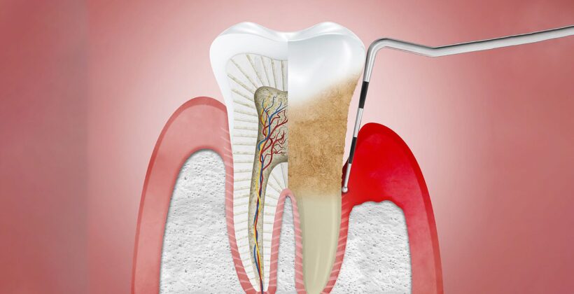 How to avoid pain during root canal treatment?