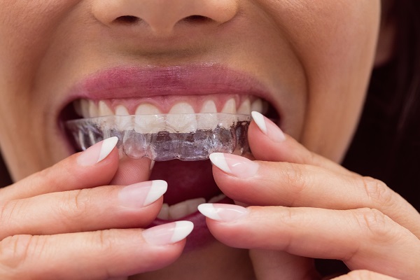 Things you should know about dental Invisalign