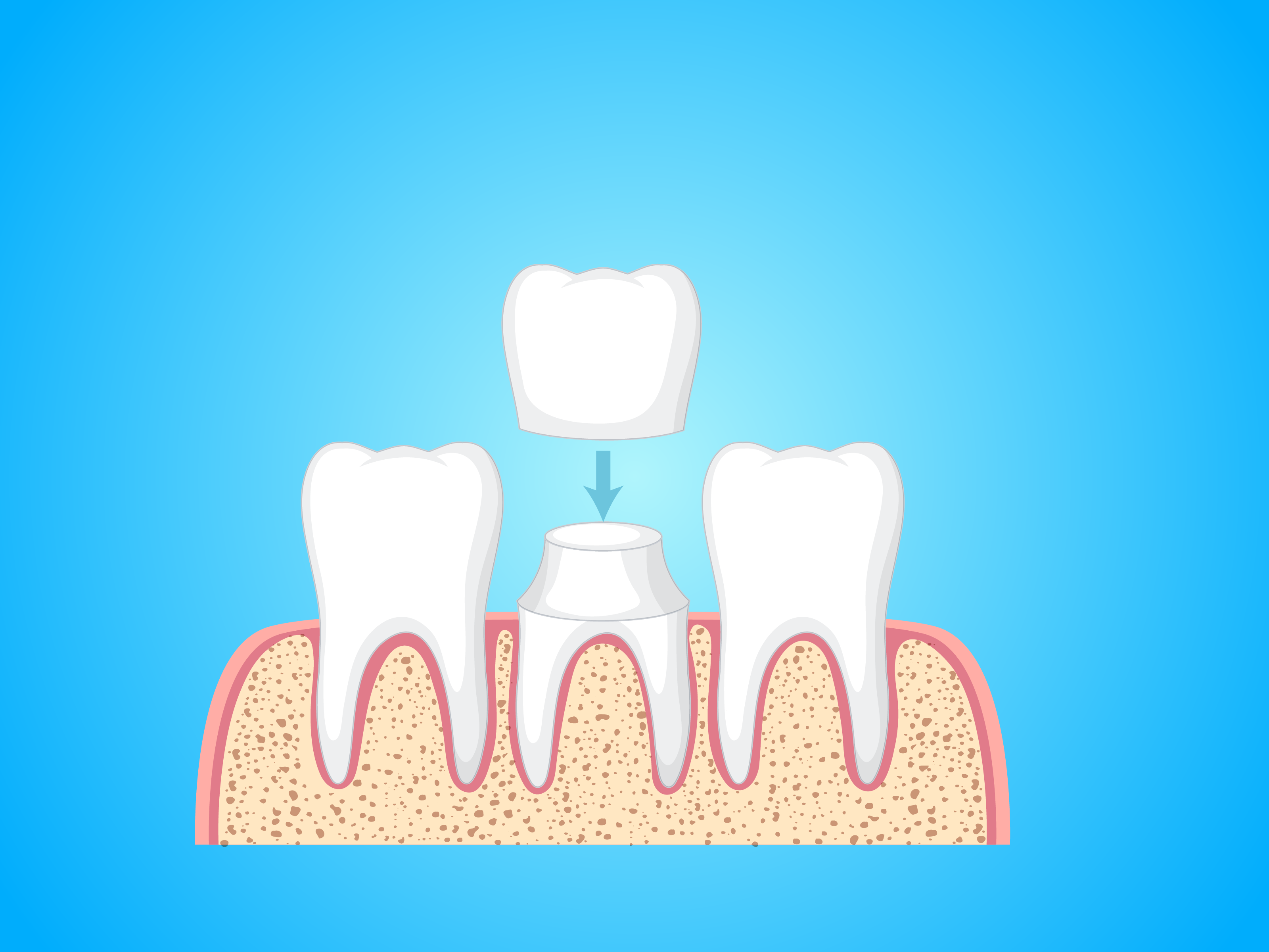 Dental Crowns – A One Stop Solution For Your Damaged Teeth