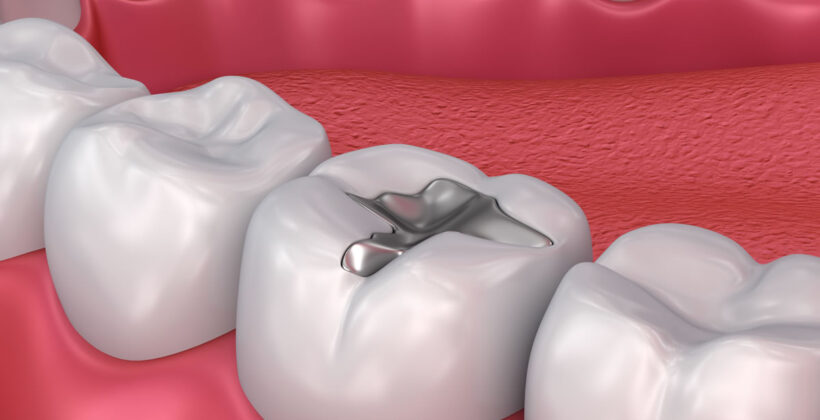 Amalgam Fillings  – A Safe and Effective Option For Dental Restoration