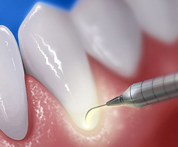 Advanced Periodontal Treatment For A Healthy Smile