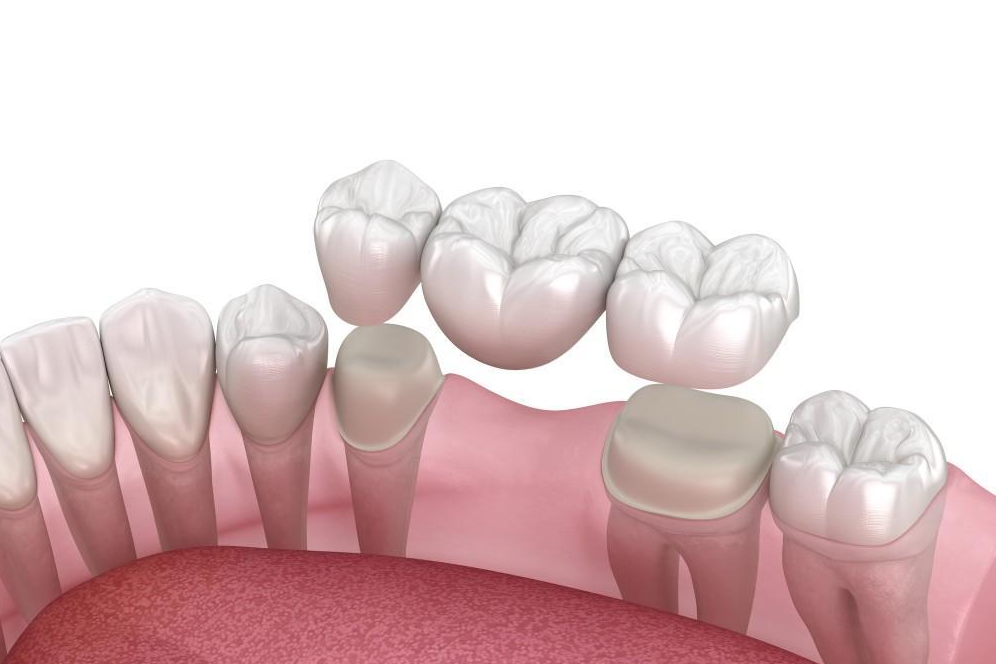 Dental Bridge Brampton