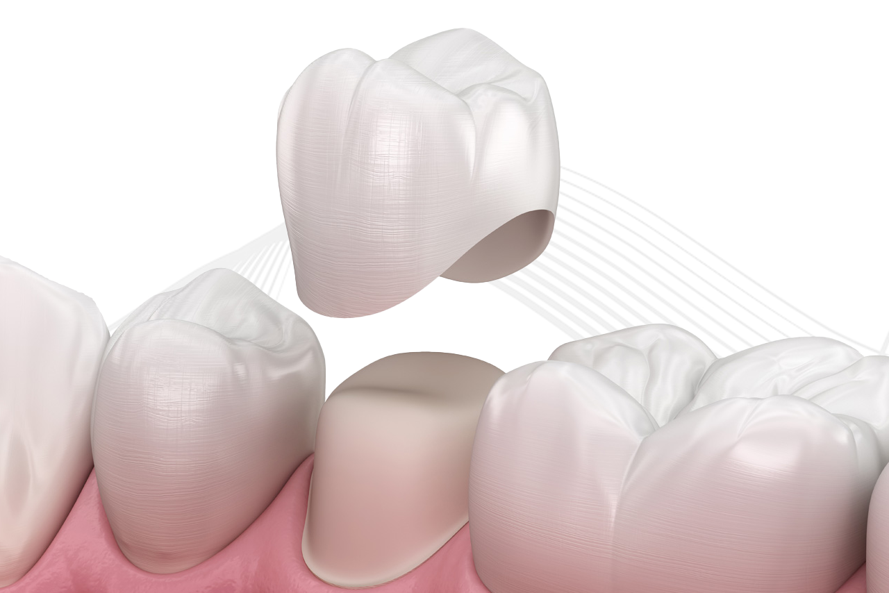 Dental crown