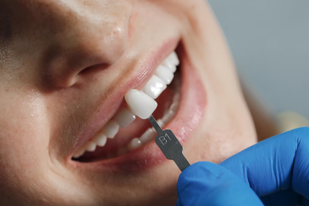 Dental Veneers in Brampton