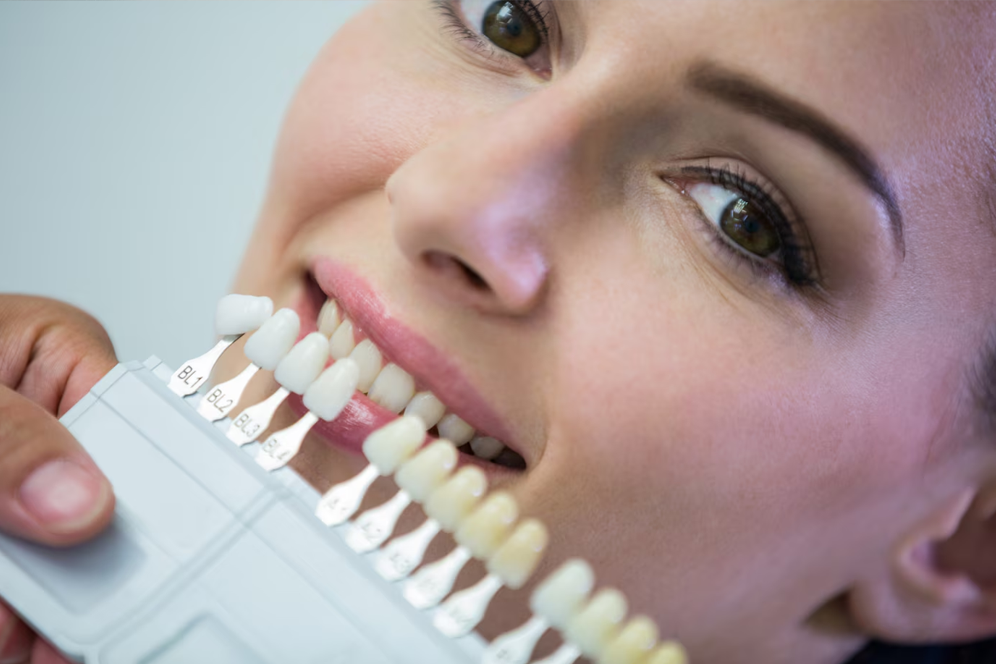 Porcelain Veneers in Brampton