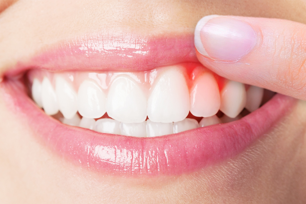 Gum Disease Treatment Brampton