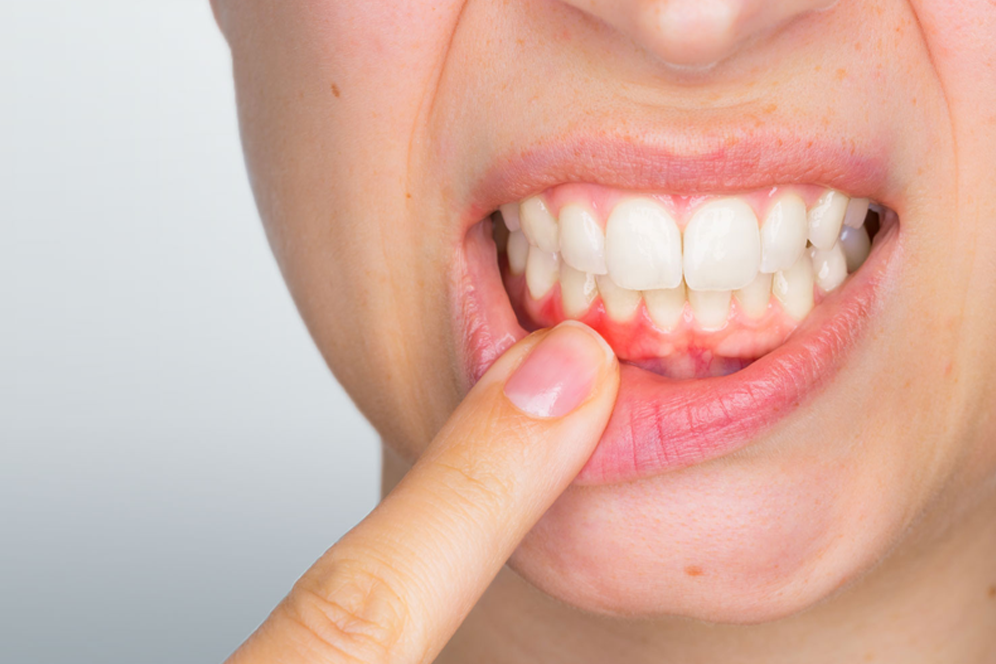 Periodontal Disease Treatment Brampton