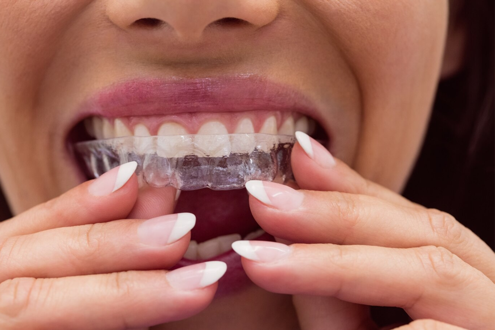 What You Need to Know About Invisalign Braces