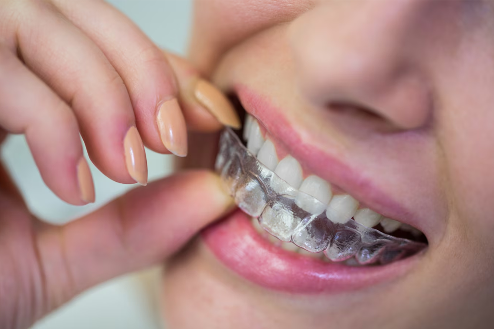 Dental Invisalign Brampton