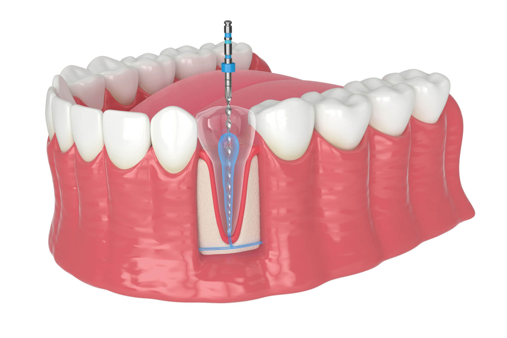 Root Canal Treatment Brampton