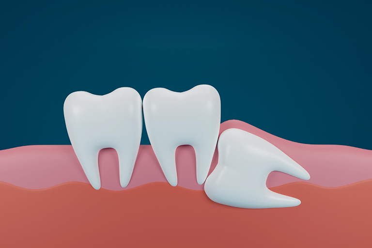 What is Involved in A Wisdom Tooth Extraction Procedure