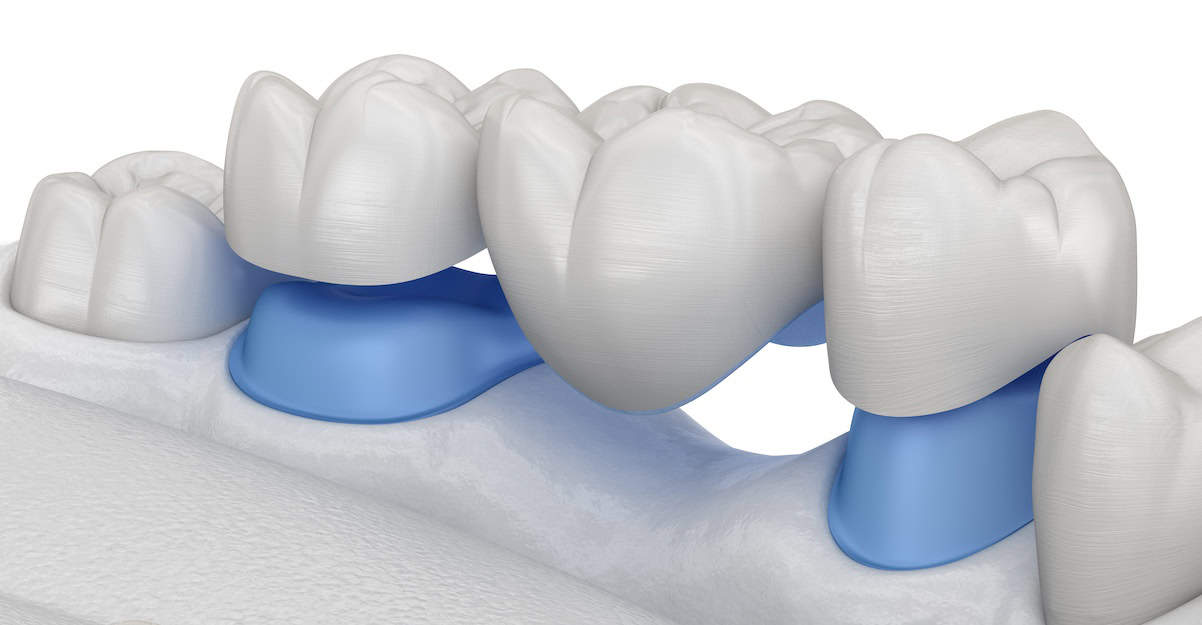 Dentist for Dental Bridges in Brampton