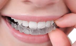 Is Invisalign Covered by Insurance