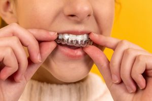 How to Find Trusted Invisalign Dentist in Brampton