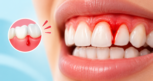bleeding gums causes