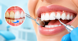 Walk-In Teeth Cleaning Near Me in Brampton
